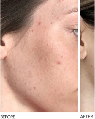 DR DENNIS GROSS SKINCARE: Alpha Beta® Universal Daily Peel