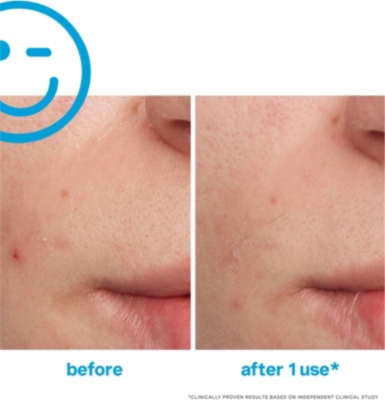 KATE SOMERVILLE: EradiKate® blemish treatment 30ml